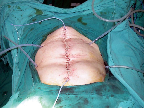 شیمی درمانی به روش هایپرترمیک اینتراپریتونیال (HIPEC )